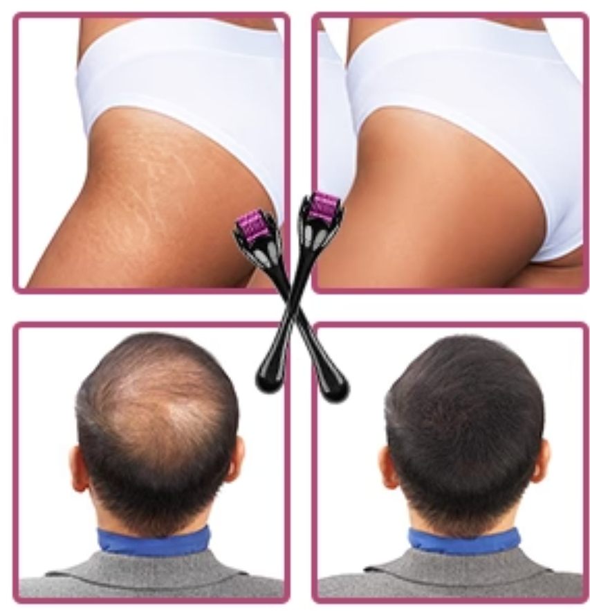 Κύλινδρος μασάζ αντιμετώπισης Τριχόπτωσης και  Ραγάδων